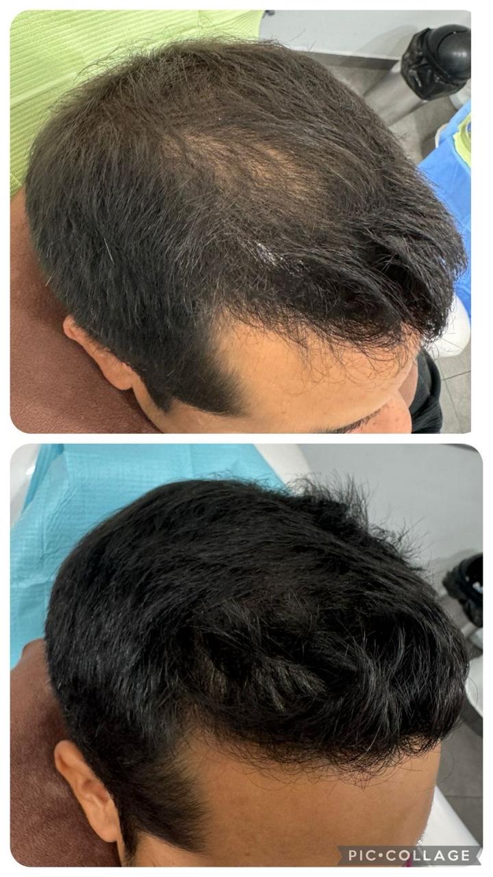 Frontal reconstruído